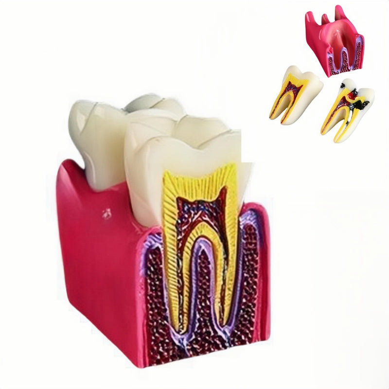 6 Times Dental Caries Model Teaching Typodont Tool for Dentists, Patients, Teachers and Students Studying and Researching (Teeth Removal) Teeth Removal