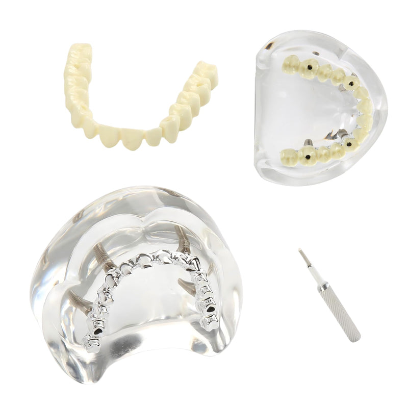 Dental Overdenture Inferior Model 4 Implants Upper Jaw Removable Demo Model | For Dentist Education and Study