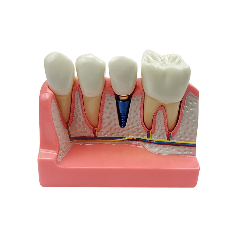 4 Times Dental Implant Model, Removable Teeth Model, Dental Implant, Crown and Bridge Model for Demonstration of Tooth Structure 4-tooth dental implant model