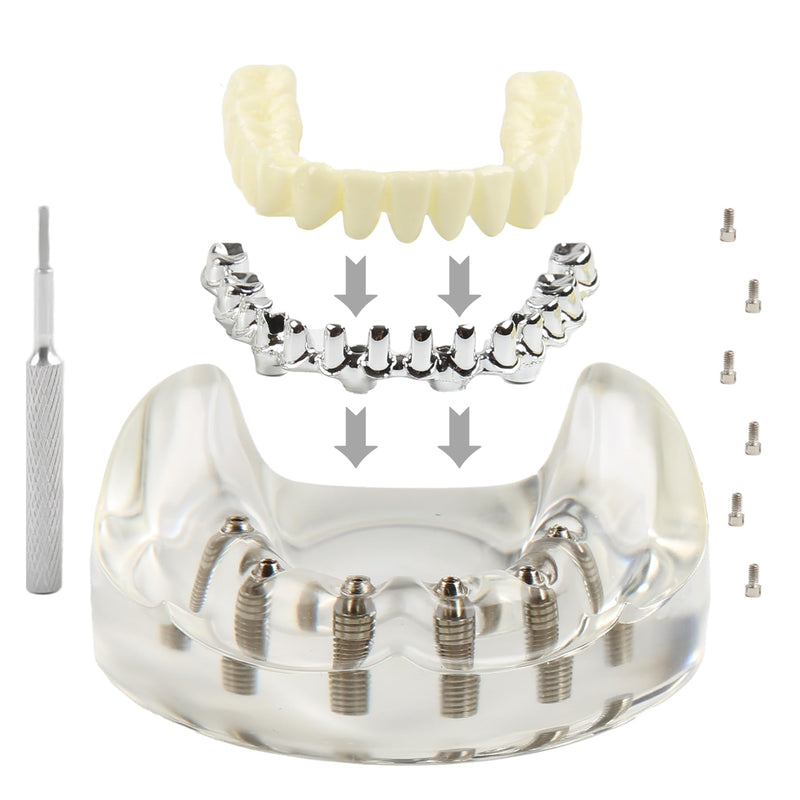 Dental Implant Model Transparent Upper Jaw with 6 Implants Removable Screws | Overdenture Restoration, Dental School Teaching Lab Demo, Patient Education