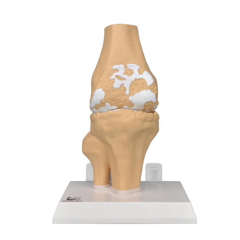 1:1 Osteoarthritis Knee Model for Orthopedic Patient Education | Shows Knee Arthritis;Explains Cartilage Wear;Magnetic Demo Design;For Clinic Teaching;Patient Education Aid