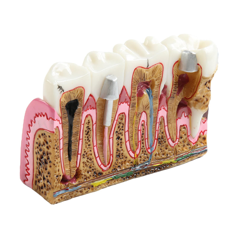Dental Caries Tooth Anatomy Model Tooth Pathology Models | Caries Evolution Model, Comprehensive Structure Teaching, Oral Study