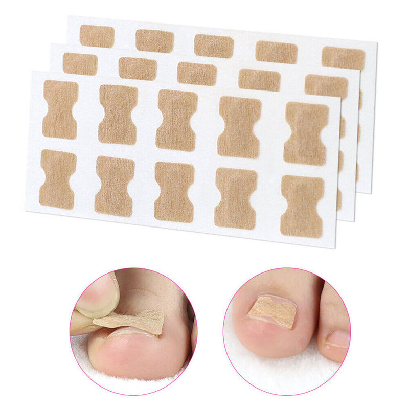 Ingrown Toenail Stick Patch, 4 Sizes Glue-free Toe Nail Correction File Patch Paronychia Corrector Foot Care Treatment Pedicure Tool Ingrown Toenail Correction Patch(1#) 1# - NewNest Australia
