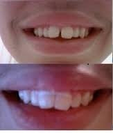 Cayenas Orthodontic Gap Teeth Bands 3/16 Heavy - 100 Bands Per Pack - NewNest Australia