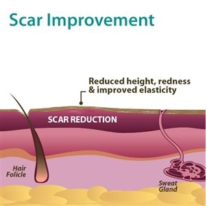 Biodermis Prosil Scar Care Silicone Rotary Pen, 17 G, Against Scars All Over The Body, Can Be Over-Make-Up, For Scar Care After Surgery And To Improve Old Scars - NewNest Australia