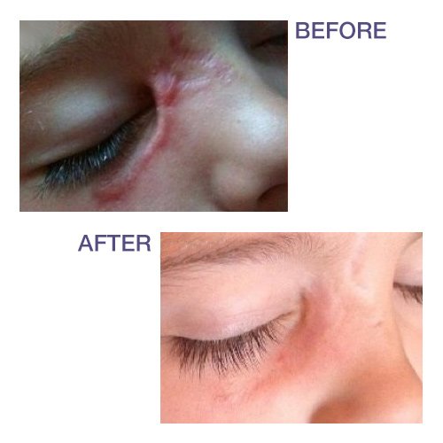Biodermis Prosil Scar Care Silicone Rotary Pen, 17 G, Against Scars All Over The Body, Can Be Over-Make-Up, For Scar Care After Surgery And To Improve Old Scars - NewNest Australia