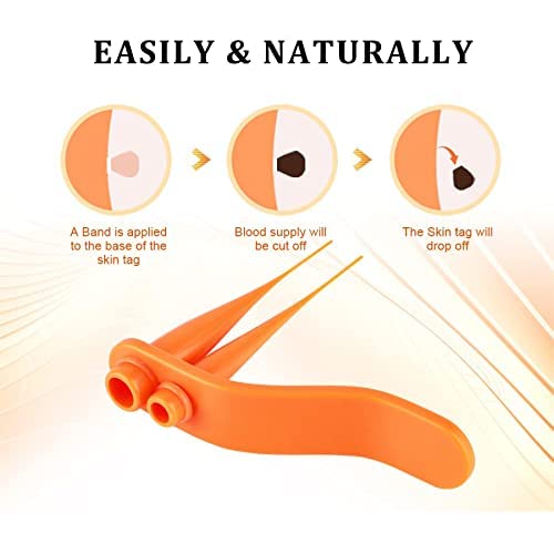 Mole Removal Skin Tag Removal Micro Band Skin Tag Removal Kit Face Body Care Painless and Safe 2 in 1 Professional Mole Wart Remover., Orange - NewNest Australia