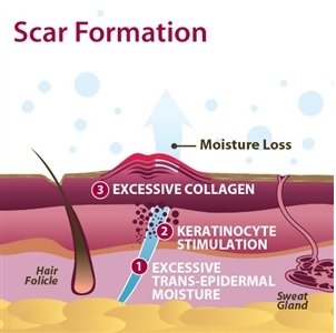 Biodermis Prosil Scar Care Silicone Rotary Pen, 17 G, Against Scars All Over The Body, Can Be Over-Make-Up, For Scar Care After Surgery And To Improve Old Scars - NewNest Australia