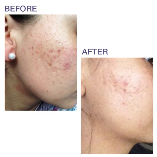 Biodermis Prosil Scar Care Silicone Rotary Pen, 17 G, Against Scars All Over The Body, Can Be Over-Make-Up, For Scar Care After Surgery And To Improve Old Scars - NewNest Australia