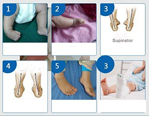 Kids AFO Drop Foot Splint Baby Ankle Foot Brace Night Splint Toddler Strephenopodia Strephexopodia Splint (18cm) 18cm - NewNest Australia