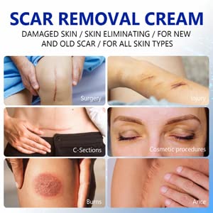 Scar Removal Cream, Skin Repair Cream for Old and New Scars, Scar Treatment Gel for Surgical Scars, Acne Scars, C-Section, Burns, Stretch Marks - NewNest Australia