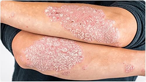 Natural Cream FOR SKIN HEALING, SKIN RENEWAL with for wounds, open wounds, bedsores, burns, sunburn, insect bites - PACK OF 2 + Italian language - NewNest Australia