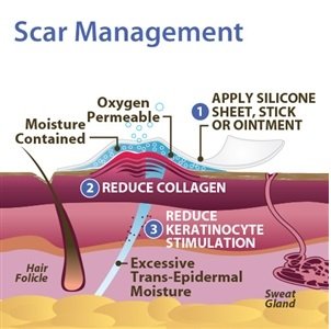 Biodermis Prosil Scar Care Silicone Rotary Pen, 17 G, Against Scars All Over The Body, Can Be Over-Make-Up, For Scar Care After Surgery And To Improve Old Scars - NewNest Australia