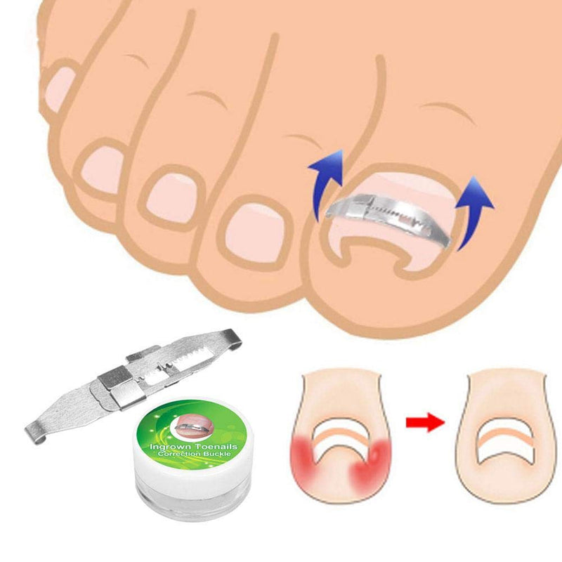 3pcs Ingrown Toenail Tools, Stainless Steel Ingrown Toenail Corrector Pain Relief Paronychia Treatment Correcting Tool for Ingrown Toe Nails Curve Correct, Correct Toes - NewNest Australia