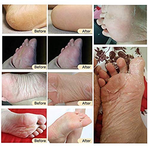 5 Pack Foot Peel Mask,Exfoliating Foot Socks Calluses Remover Dead Skin, Aloe Moisturizing Feet Peeling Mask for Dry Skin,Cracked Heels,Foot SPA Socks for Women and Men (Rose) Rose - NewNest Australia