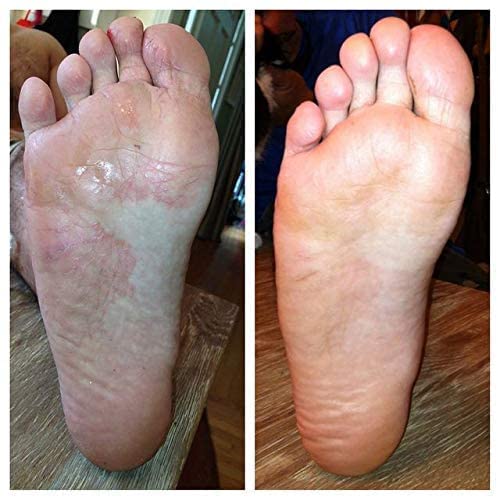 Nail fungus and athlete's foot spray | Shoe Spray Antibacterial | Nail fungus spray shoes | 150ML - NewNest Australia