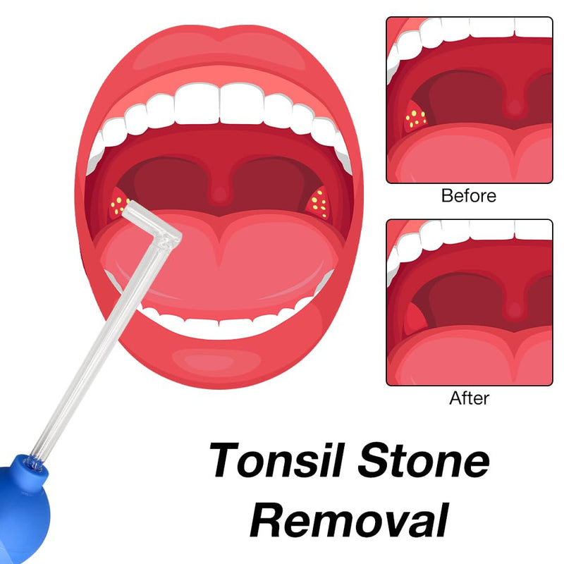 AVCXEC Tonsil stone removal, tonsil stone remover, tonsil stone cupping glass for removing tonsil stones, Tonsil Stone Remover, Tonsilclin tonsil stone cupping glass for fresh breath - NewNest Australia