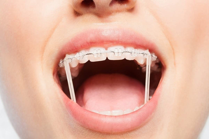500 Pcs Orthodontic Elastic Rubber Bands, 3.5 Ounces Heavy Dental Rubber Traction Bands, Free Elastic Placer for Braces (1/4",Fox) 1/4",Fox - NewNest Australia