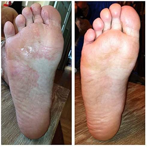 Powerful Foot Fungus Ointment | Foot Athlete'S Foot Cream Treatment Quick Intensive | Skin And Foot Thorough And Effective Treatment | Xl 75Ml | Imperial Feet - NewNest Australia