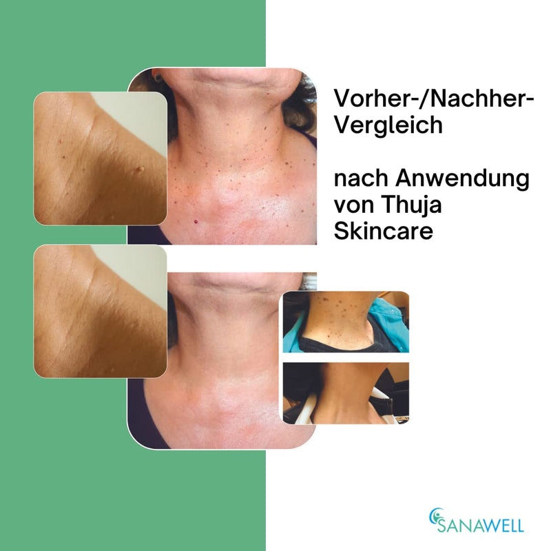 Skin fluid | Wart Remover | Wart remedies | Stem & age warts | Fibromas | Wart tincture | Anti-wart remedies | without de-icing | gentle removal - NewNest Australia