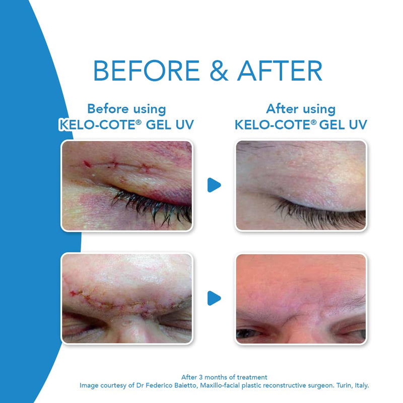 Alliance Pharmaceuticals GmbH Kelo-cote silicone gel for the treatment of scars 15 g - NewNest Australia