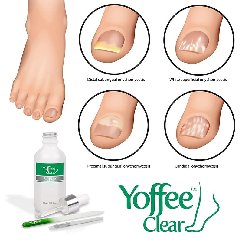 Yoffee Clear Nail Repair and Care 60ml - Fungal Nail treatment for fingernails and toenails - Antibacterial and Antiseptic - Antifungal with organic argan oil and tea tree oil - Made in Spain 60 ml (Pack of 1) - NewNest Australia