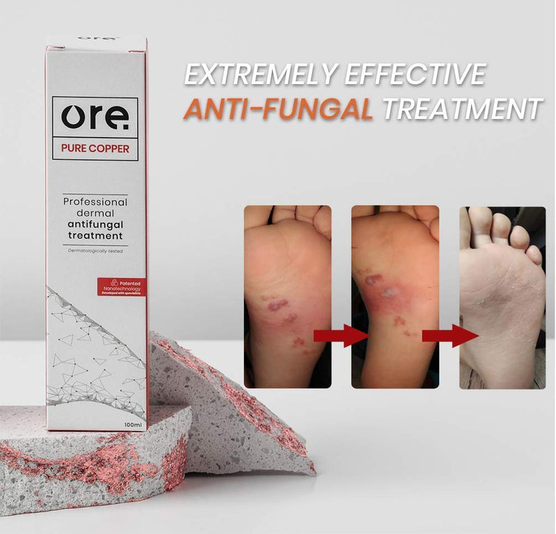 Ore® ● Professional Dermal Anti-fungal Treatment (Cure&Prevent) ● 100% Natural ● 100ml/700+ Sprays ●Athletes Foot, Ringworm, Jock Itch, Smelly Feet & Nail Fungus ● Recommended by Podiatrists - NewNest Australia