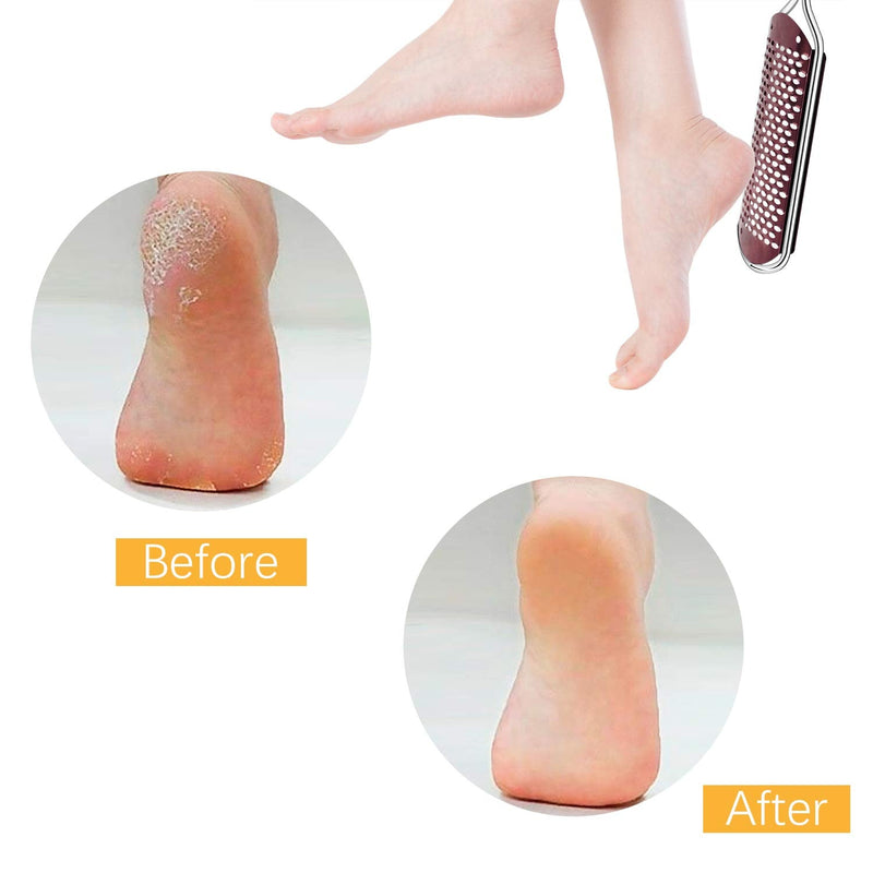 Callus File Callus Remover For Callus Removal Foot, Callus Rasp Foot Callus Remover Professional Stainless Steel Foot File Foot Rasp For Wet And Dry Feet (Rose Gold) - NewNest Australia