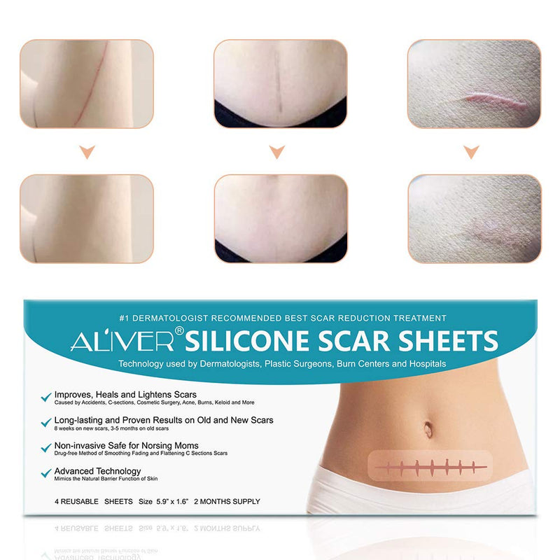 Silicone Scar Removal Sheets Fast & Effectively Removes Scars For C Sections, Acne, Surgery, Burns And More Reusable Scar Strips [15 X 4Cm] - 4 Pack (2 Month Supply) - NewNest Australia