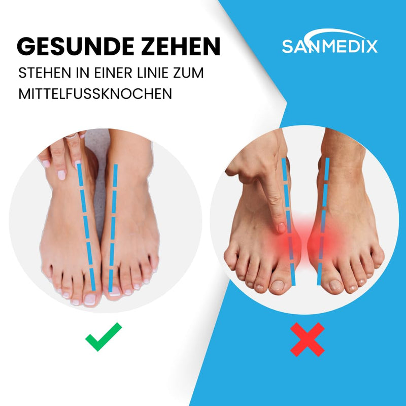 Sanmedix Hallux Valgus toe separator training band for the toe - correction set for men and women to relieve pain from bunions basic - NewNest Australia