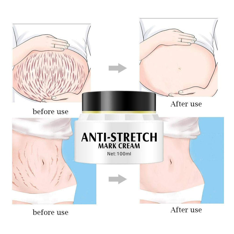 Stretch Marks Removal Cream, Stretch Marks Cream, Skin Repairing Scar Removal Treatment 100ml - NewNest Australia