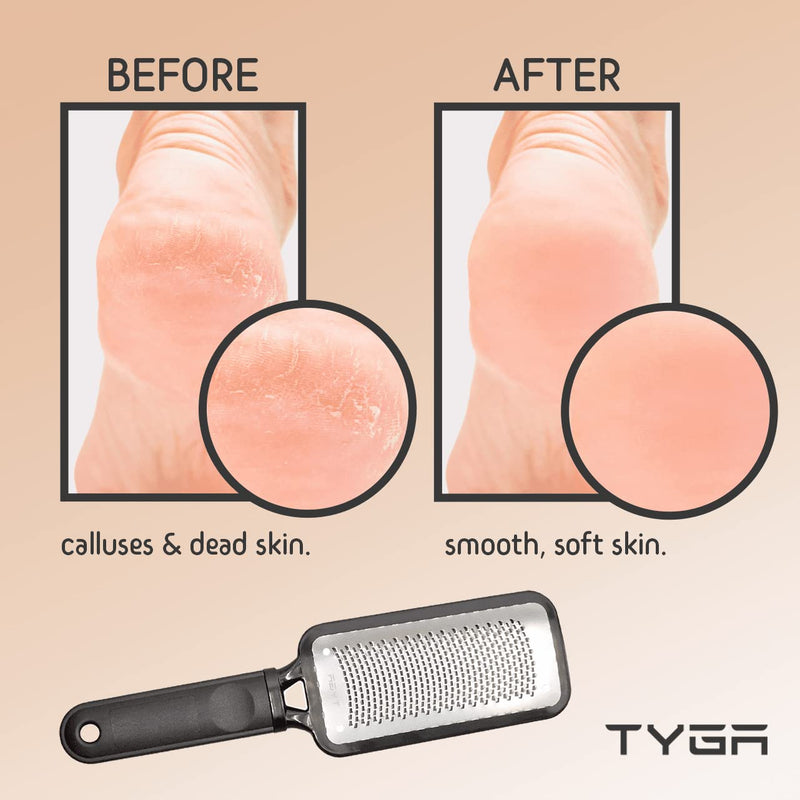 Tyga Foot Rasp Foot File And Callus Remover - Pedicure Tool For Removing Dead Skin, Feet Hard Skin Remover, Foot Scraper, Can Be Used On Both Wet And Dry Feet - NewNest Australia