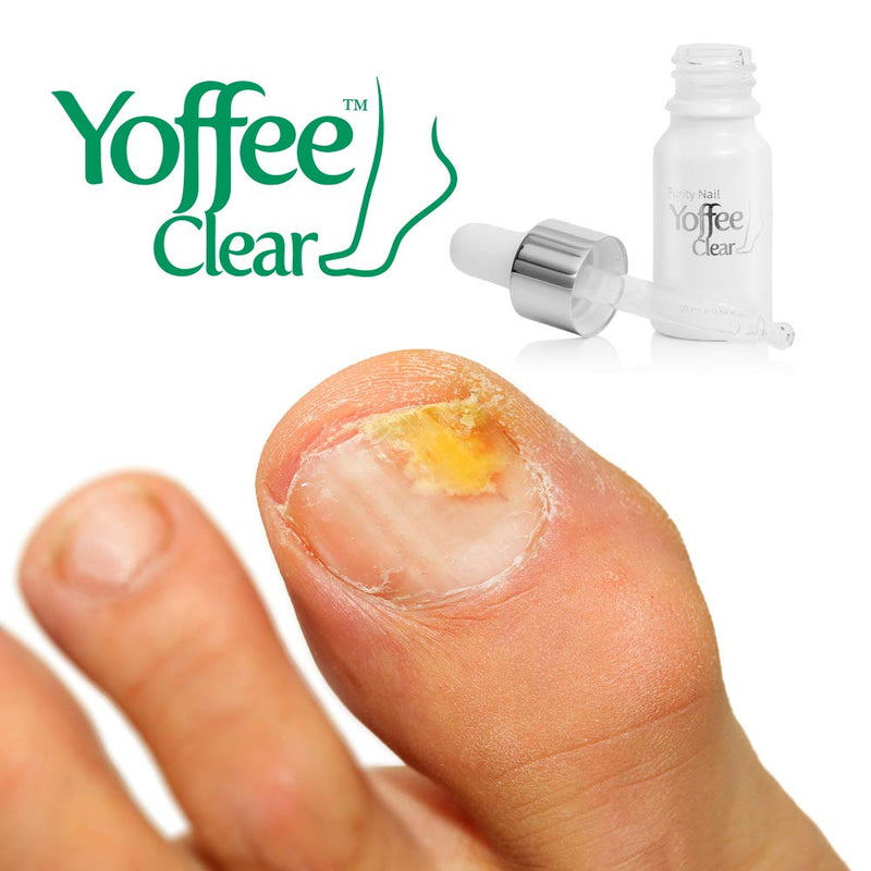 Yoffee Clear Nail Care - Anti Fungal Nail Treatment for Finger and Toenails - 10 ml - Antibacterial and Antiseptic - Fungal with Organic Argan Oil and Tea Tree Oil - Concentrated Formula/Made in Spain 10 ml (Pack of 1) - NewNest Australia