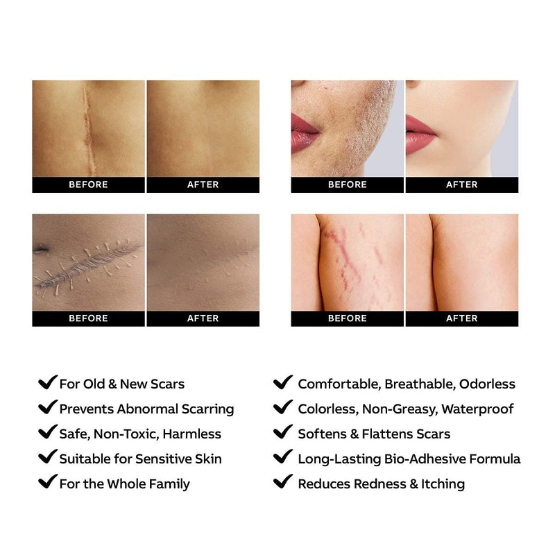 AZALLY Advanced Scar Gel - Scar Diminishing Serum - Reduces The Appearance of Old & New Scars - Best Scar Treatment for Repair Scars from Burns Cuts Acne Spots Stretch Marks - NewNest Australia