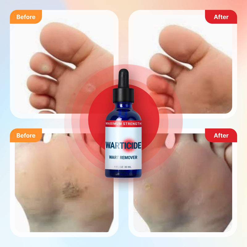 WARTICIDE Fast-Acting Wart Remover - Plantar and Genital Wart Treatment, Attacks Warts On Contact, Easy Application (1 Fluid Ounce) 1 Fl Oz (Pack of 1) - NewNest Australia