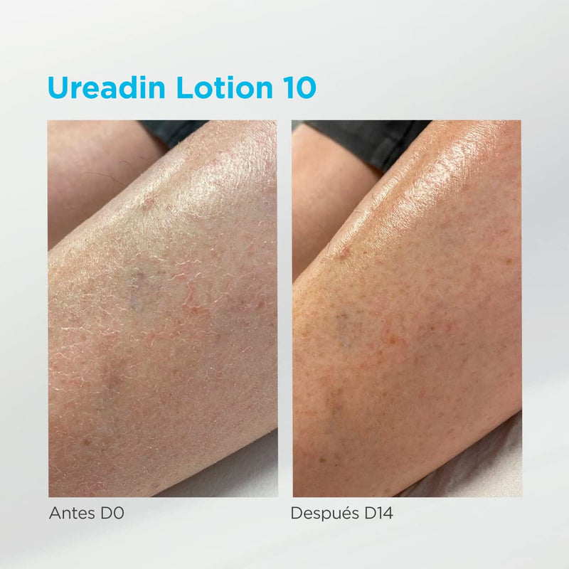 ISDIN Ureadin Lotion 10 (1000ml) | Body lotion with intensive moisture supply for dry skin 10% Urea 1 l (pack of 1) - NewNest Australia