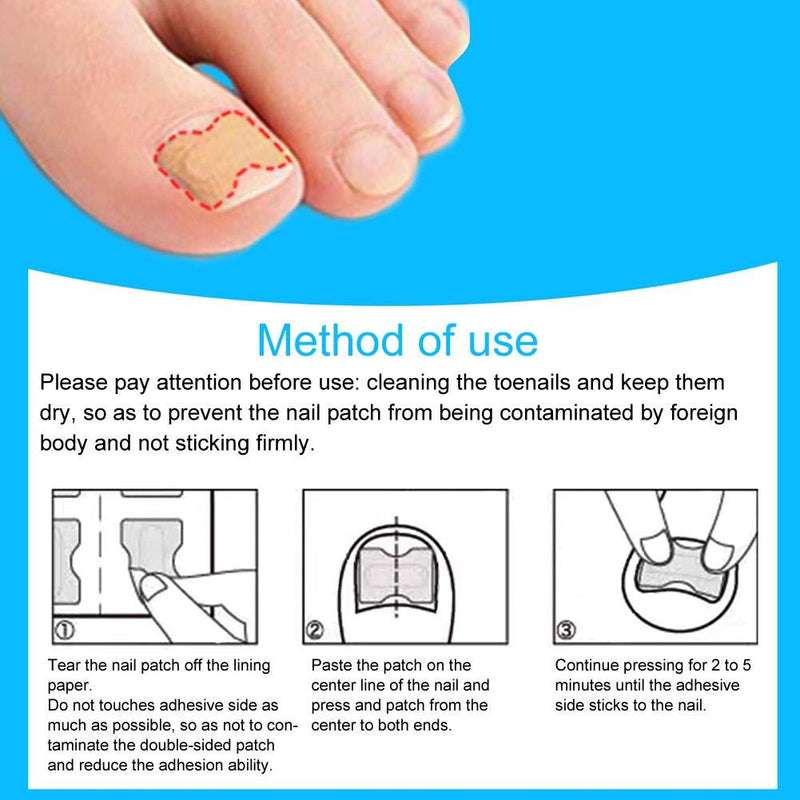 Ingrown Toenail Stick Patch, 4 Sizes Glue-free Toe Nail Correction File Patch Paronychia Corrector Foot Care Treatment Pedicure Tool Ingrown Toenail Correction Patch(1#) 1# - NewNest Australia