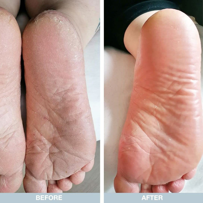 Foot Care Duo for Dry Feet and Cracked Heels - Moisturizing Foot Cream and Intensive Heel Repair for Soft and Smooth Skin - Soothing Formula with Antifungal Properties - Perfect for Athletes Foot - NewNest Australia