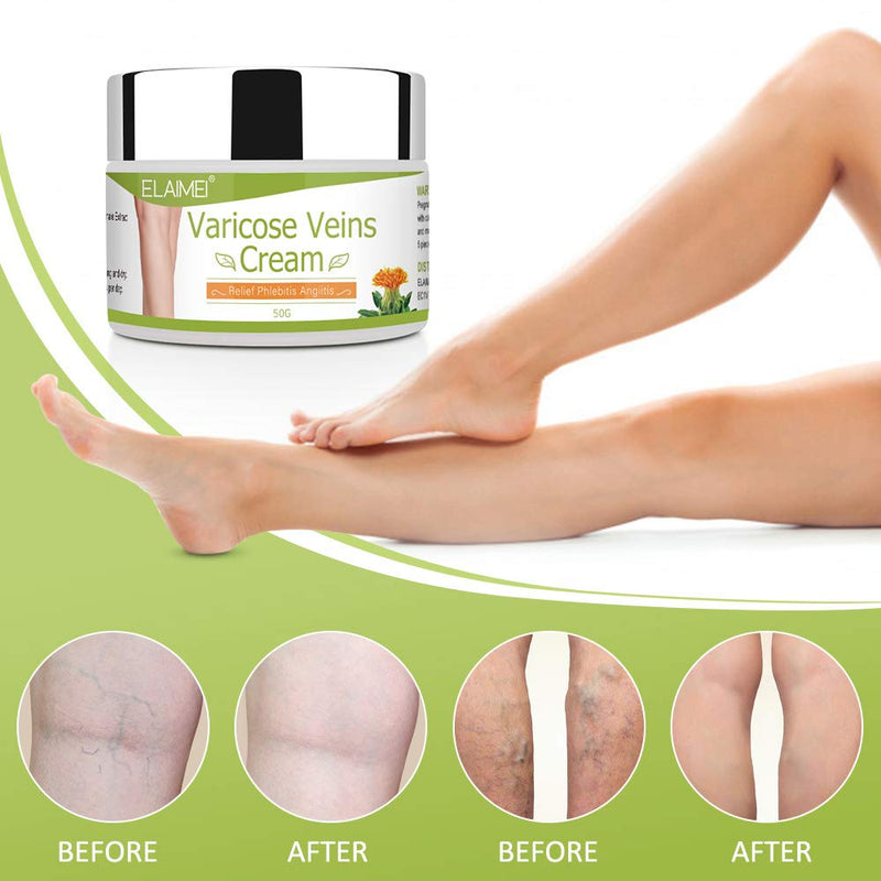 Varicose Veins Cream, Relief Phlebitis Angiitis Inflammation Blood Vein Veins Vasulitis Treatment Legs spider Veins, Improve Blood Circulation, Tired and Heavy Legs Fast Relief - NewNest Australia