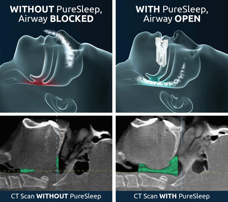 PureSleep Anti-Snoring Mouthpiece – Helps Stop Snoring – The Original Anti-Snoring Solution – Comfortable & Adjustable – Over a Million Units Sold – Made in The USA - NewNest Australia