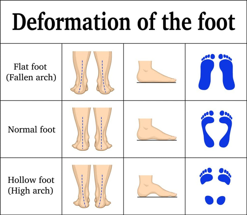 Kingmed Men'S Orthopedic Insoles For Shoes | Supination | Valgus Knee And Heel | Shoe Abrasion | Medical Device | Handmade | Handmade | Checked Fabric | Size 8 | 10.8 Inches - NewNest Australia