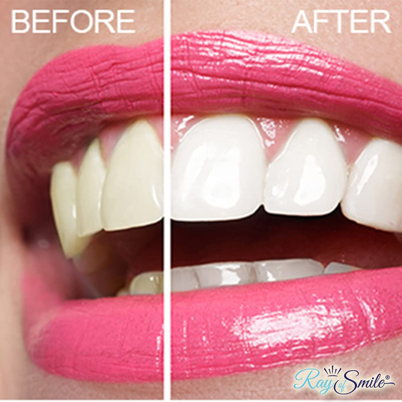 Lovely Smile - 28 Teeth Whitening Strips - Sensitivity Free - Express - Whiter Teeth in 1 Hour - Enamel Safe White Strips by Ray of Smile - NewNest Australia
