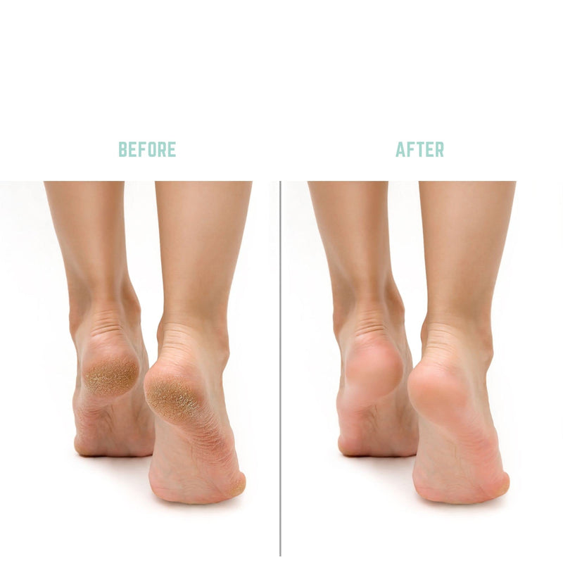 PediCurve Electric Callus Remover, Unique Callus Remover that Gently Removes Calluses | Electric Callus Remover via Solar Cells or with USB - NewNest Australia