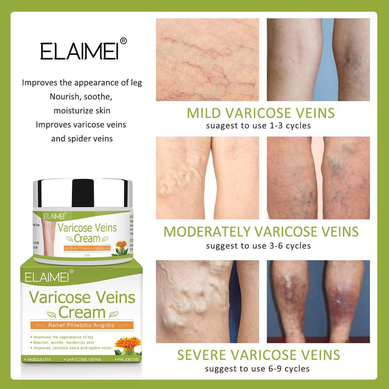 Varicose Veins Cream, Relief Phlebitis Angiitis Inflammation Blood Vein Veins Vasulitis Treatment Legs spider Veins, Improve Blood Circulation, Tired and Heavy Legs Fast Relief - NewNest Australia