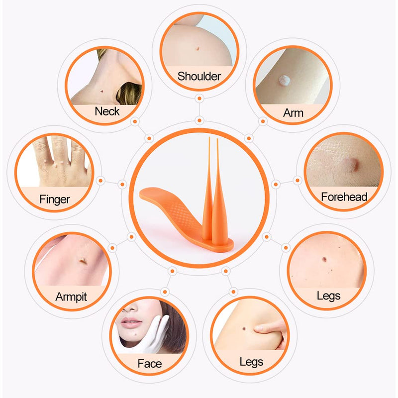Mole Removal Skin Tag Removal Micro Band Skin Tag Removal Kit Face Body Care Painless and Safe 2 in 1 Professional Mole Wart Remover., Orange - NewNest Australia