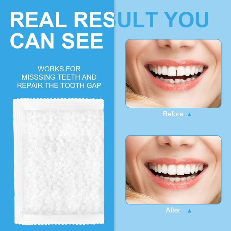 Acwoo Temporary Tooth Repair, Tooth Repair Glue, Heat Beads For Filling, Fixing The Missing And Broken Tooth Or Gluing The Artificial Teeth Of The Prosthesis (50G) - NewNest Australia