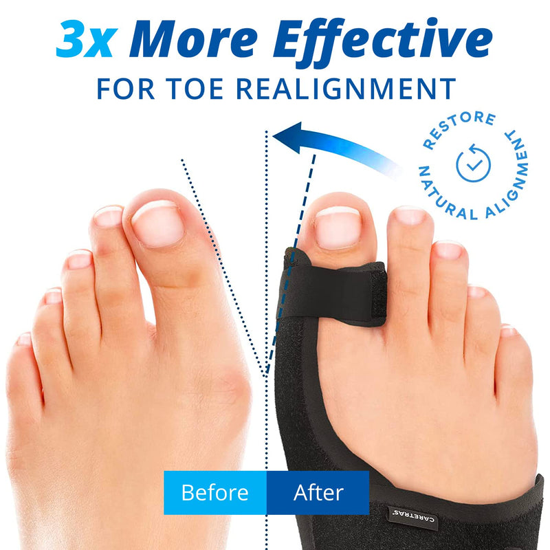 Wifamy Bunion Corrector big toe straightener, Toe Separators to Correct Bunions, Toe Spacers for Pain Relief, Hallux Valgus Brace Toe Stretch Band – Lightweight, Comfortable and Breathable - NewNest Australia