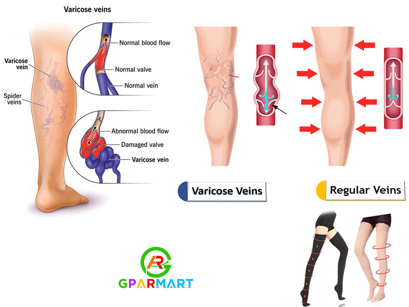 GPAR PREMIUM Medical compression stockings class 2, unisex, 23-32 mmHG, closed toe thigh-high stockings for varicose veins, edema, leg pain, thrombosis SIZE: XL COLOR: BEIGE - NewNest Australia