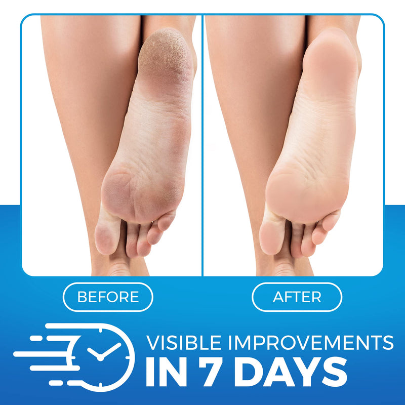 Imperial Feet Urea Foot Balm - Natural Urea Cream for Rough & Dry Skin, Calluses - Cracked Heel Treatment with Cleansing, Moisture-Binding Exfoliating Formula - Wild Herb Antioxidant Extract - 150ml - NewNest Australia