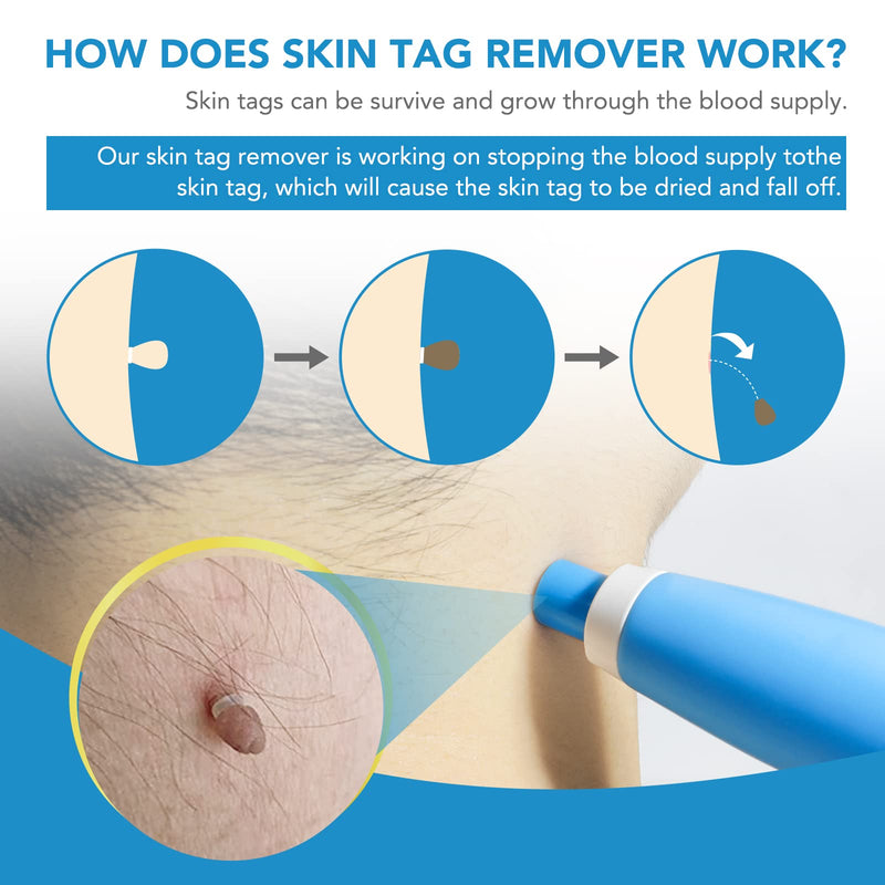 Auto Skin Tag Removal Tool Kit, 2 in 1 Skin Tag Remover Device, 2mm to 8mm Auto Wart Remover, Safe & Painless & Easy Remover Clear Skin Tag & Mole at Home,with 40 Removal Bands & 10 Cleansing Wipes - NewNest Australia